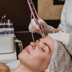 microneedling